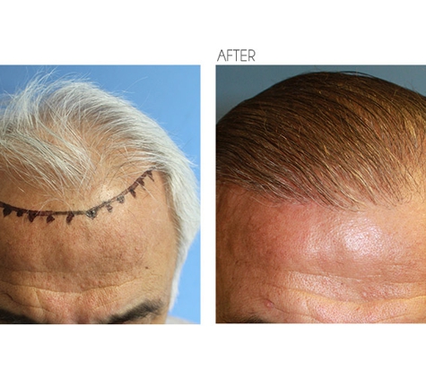 Beverly Hills Hair Restoration - Beverly Hills, CA