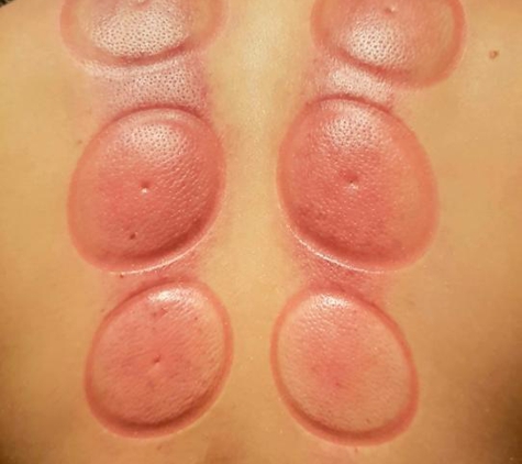 Anna's Sports and Rehabilitation Massage - High Wycombe, WA. The results after cupping and massage session. The marks only lasted a couple  of days. Buy my back and shoulders continued to feel loose long after the marks had gone.