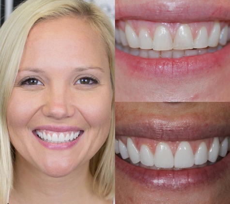 Beacon Place Dental Group - Brookline, MA. We provide porcelain veneers.