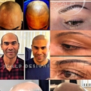 Scalp Design - Hair Replacement