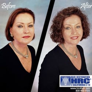 HRC - Hair Restoration of California - Los Angeles, CA