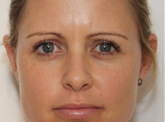OPM® Organic Permanent Makeup - Los Angeles, CA. Before opm