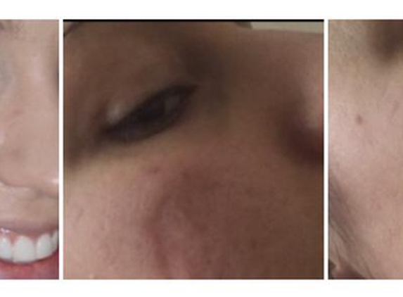 Peter Randle - Subiaco, WA. Mole before and after Surgery.