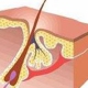 Hairadicator Electrolysis