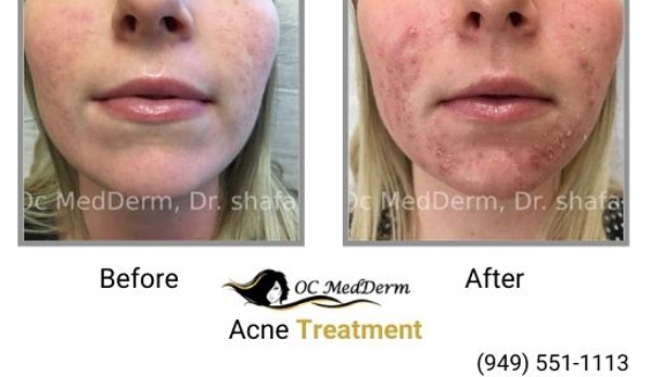 Oc Medderm - Irvine, CA. Acne Treatment