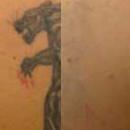 Skin City Laser - Tattoo Removal