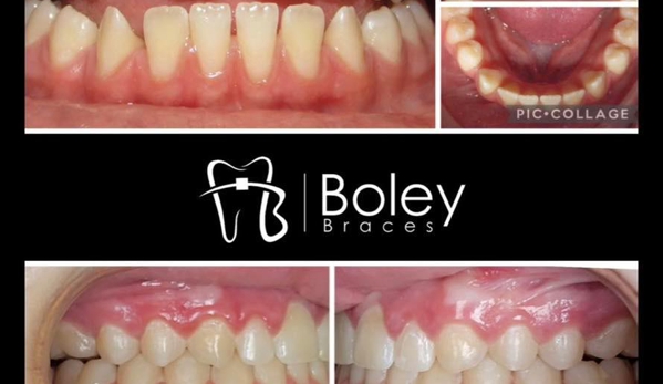 Boley Braces - Cincinnati, OH