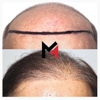 MAXIM Hair Restoration gallery