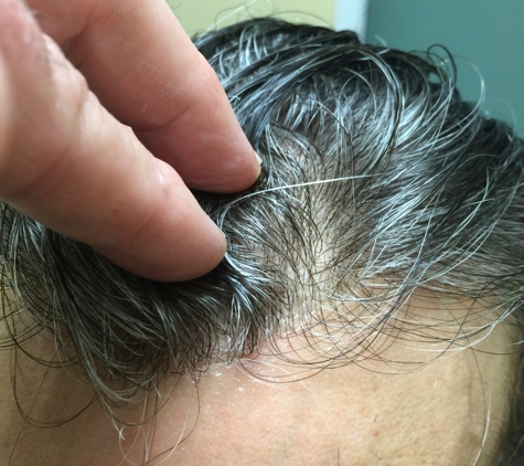 Thinning Hair Solutions - Stamford, CT