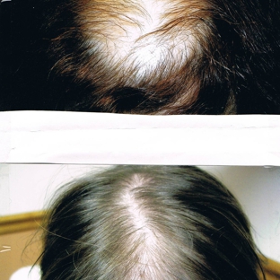 Tampa Bay Hair Restoration - Clearwater, FL