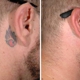 ReversaTatt Tattoo Removal