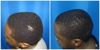 Houston Hair Transplant Center - Hair Replacement