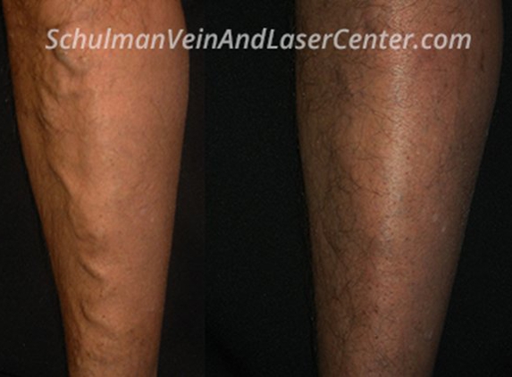 Martin Schulman, MD - Schulman Vein and Laser Center - Commack, NY