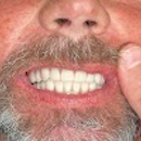 Tampa Dental Implants - Dentists