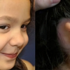 Microtia Congenital Ear Institute