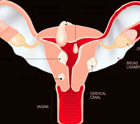 Miami Uterine Fibroid Treatment Specialists - Aventura, FL