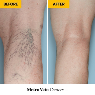 Metro Vein Centers | Dearborn - Dearborn, MI