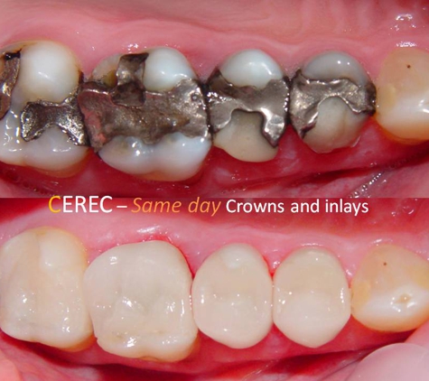 Sundial Dental Wauchope - Wauchope, NSW. Cerec crowns