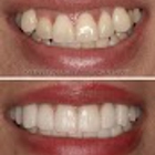 Dental Veneers Specialist on Wilshire