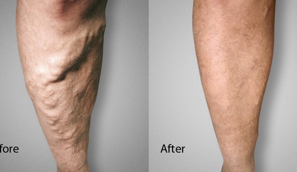 Advanced Varicose Vein Treatments of Manhattan - New York, NY