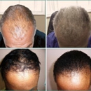 Hair Loss Control Clinic (HLCC) Latham - Hair Replacement