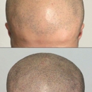 Semper Hair Scalp Micropigmentation - Hair Replacement