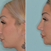 Facial Plastic Surgery Miami gallery