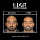 Tampa Hair Restoration Center - Hair Replacement