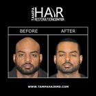 Tampa Hair Restoration Center