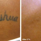 Eraser Clinic Laser Tattoo Removal