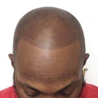 Impressions Scalp Micropigmentation