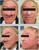 Jon Mathy, MD - Hair Replacement
