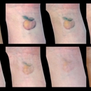 Removery Tattoo Removal & Fading - Tattoo Removal