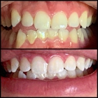 Carte Blanche Teeth Whitening