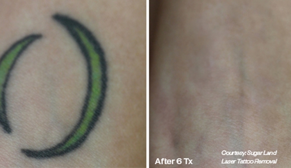 Laser Tattoo Removal by Tatt Cemetery - Fort Myers, FL