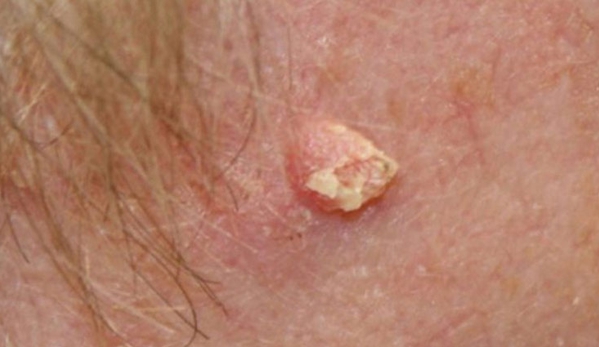 Port Macquarie Skin Cancer Clinic - Port Macquarie, NSW