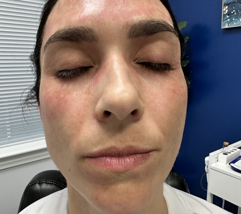 Glowing Skin Solutions LLC - Jacksonville, FL. post microneedling treatment