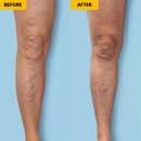 Metro Vein Centers | Bronx, Morris Park