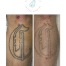 Erase & Embrace Tattoo Removal - Tattoo Removal