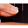 The Neighborhood Acupuncture Project gallery