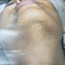 Flash Electrology - Hair Removal