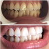 Diamond Smiles Teeth Whitening gallery