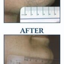 Idaho Dermatologic Surgery & Laser Center - Hair Removal