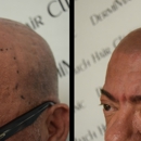 DermiMatch Hair Clinic - SMP (scalp micropigmentation) - Hair Replacement