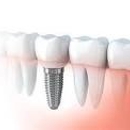 Brandywine Dental Services Group - Implant Dentistry