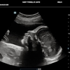 Peek a Boo Baby 3D 4D Ultrasound gallery