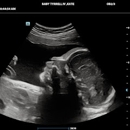 Peek a Boo Baby 3D 4D Ultrasound - Medical Imaging Services